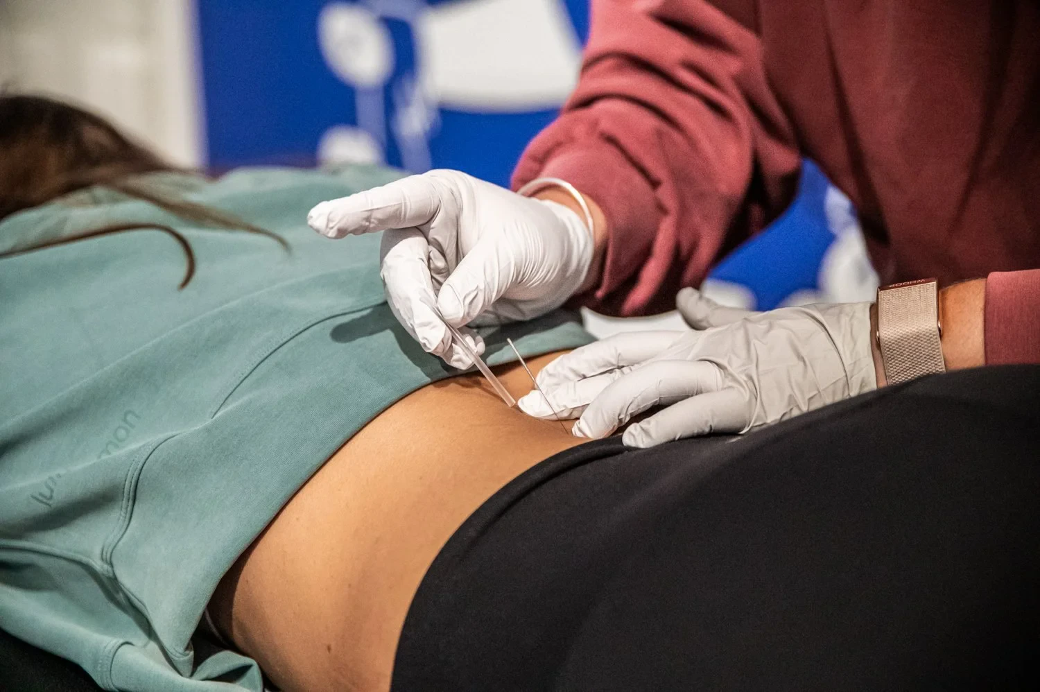 Unlocking Relief with Dry Needling in Pelvic Health